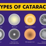 Types-of-Cataract