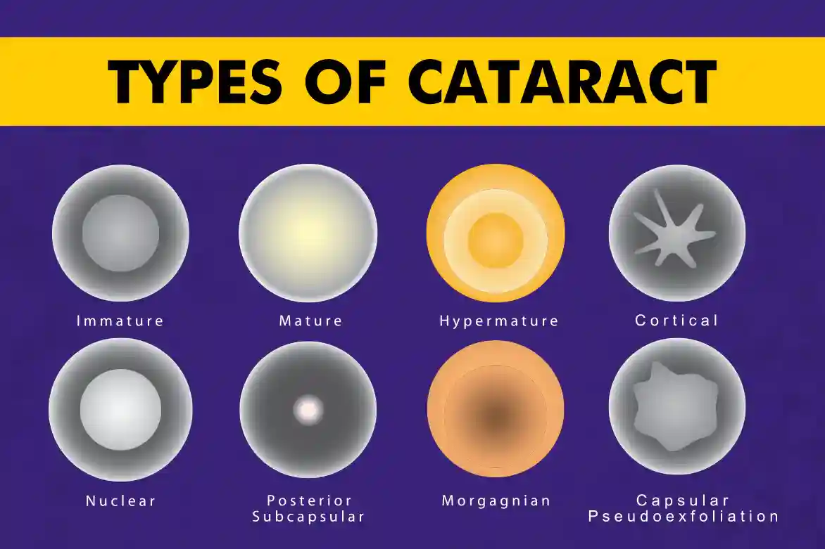 Types-of-Cataract