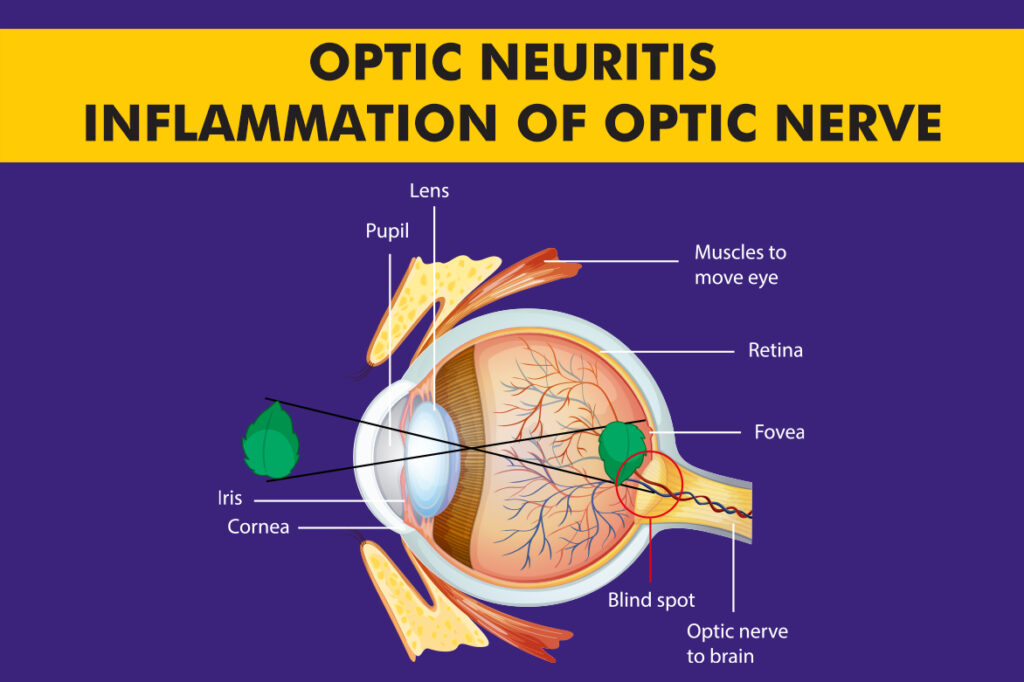 Optic Neuritis – Inflammation of Optic Nerve