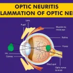 Optic-Neuritis-Inflammation-of-Optic-Nerve.