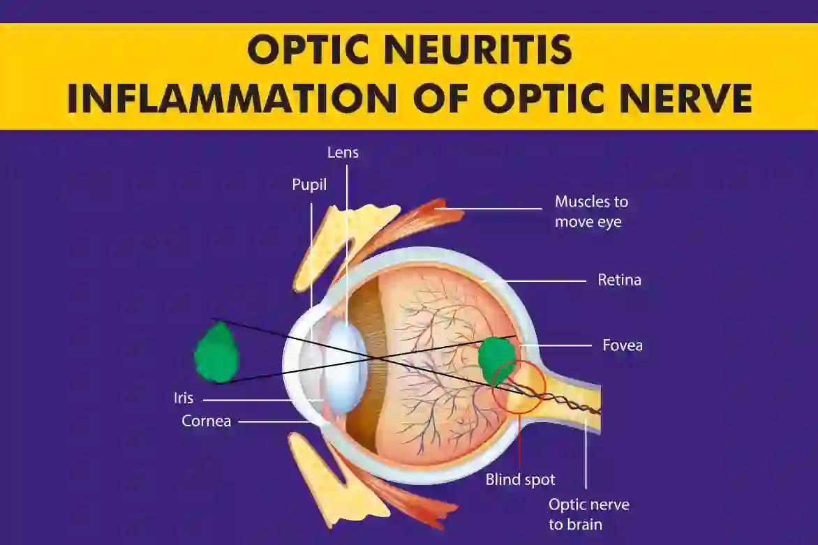 Optic-Neuritis-Inflammation-of-Optic-Nerve.