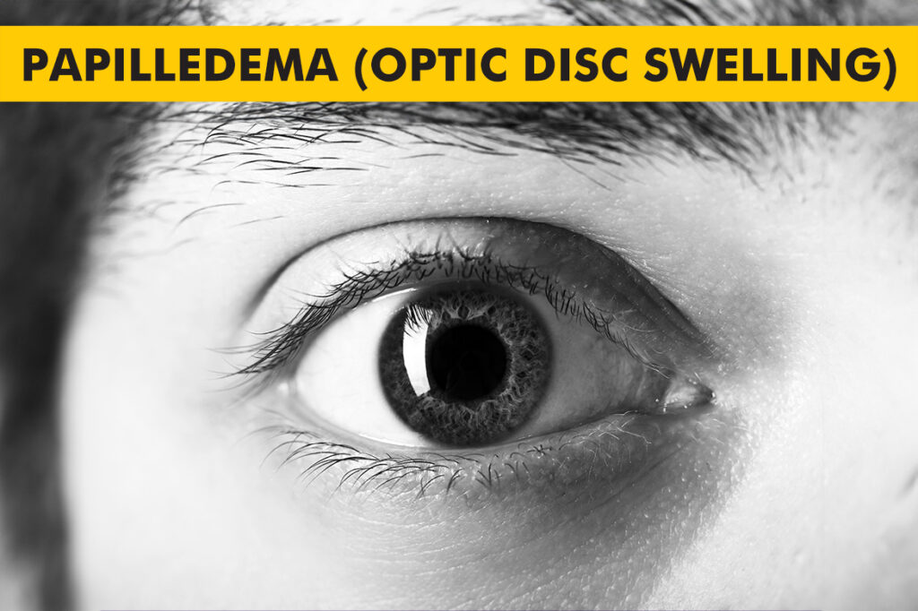 Papilledema​ (Optic Disc Swelling) – Symptoms, Causes and Treatment