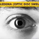 Papilledema-Optic-Disc-Swelling.