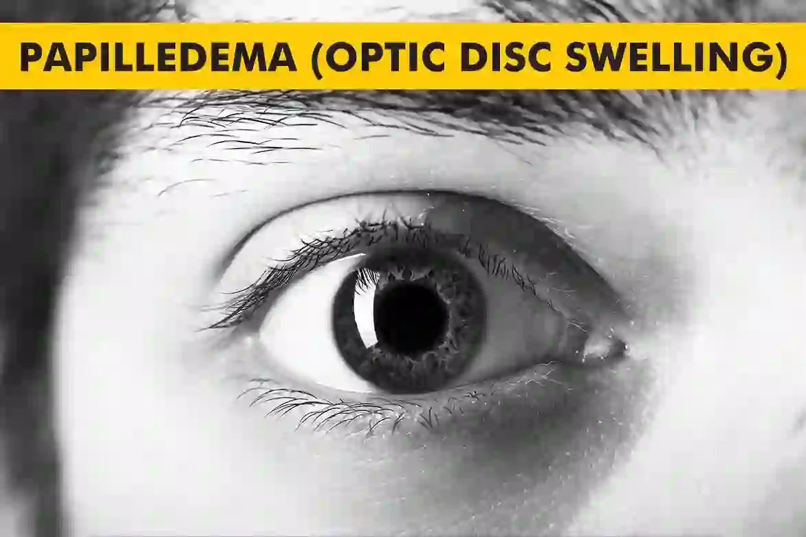 Papilledema-Optic-Disc-Swelling.