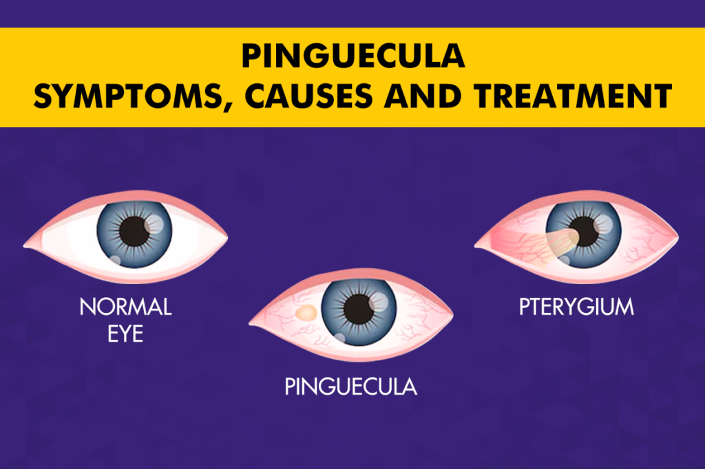 Pinguecula​ – Symptoms, Causes and Treatment