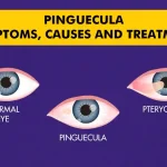 Pinguecula_-Symptoms-Causes-and-Treatment.