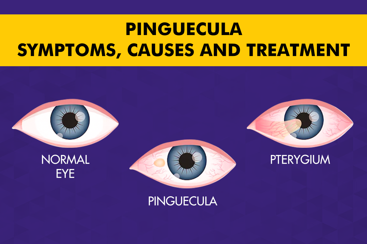 Pinguecula