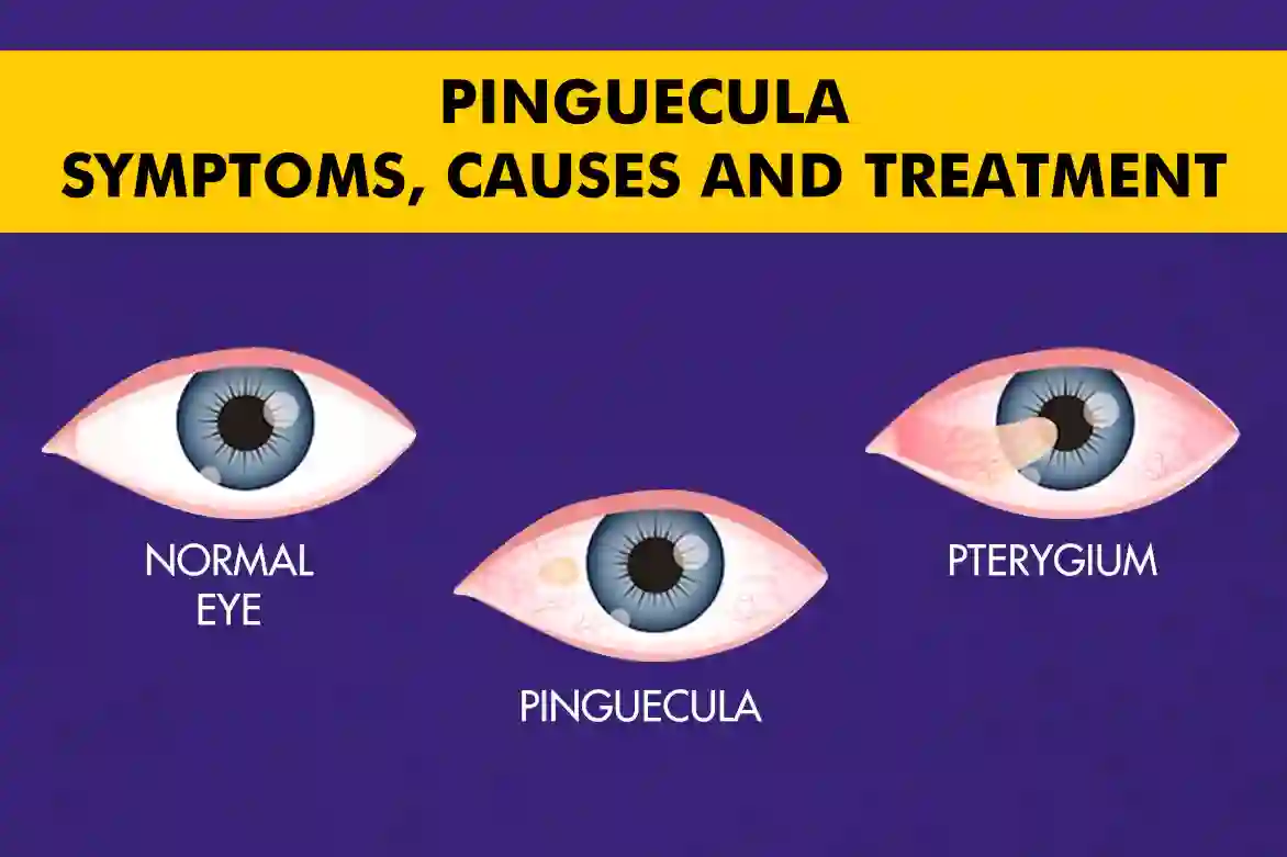 Pinguecula_-Symptoms-Causes-and-Treatment.