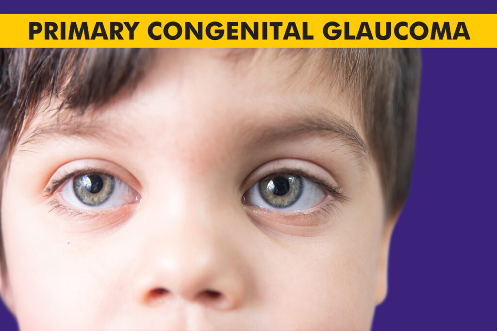 Primary Congenital Glaucoma – Causes, Symptoms & Treatments