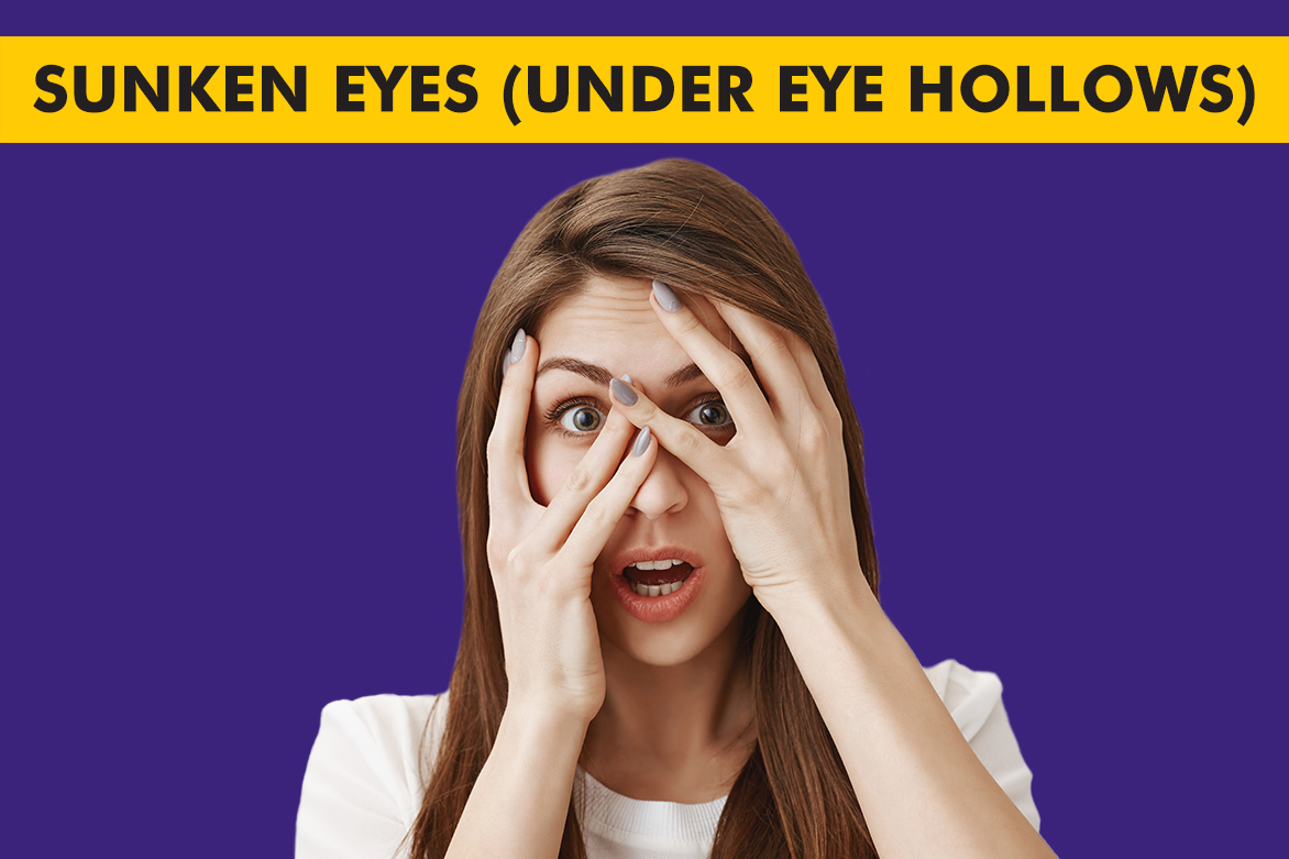 What is Sunken eyes (Under Eye Hollows) ? | Centre for Sight