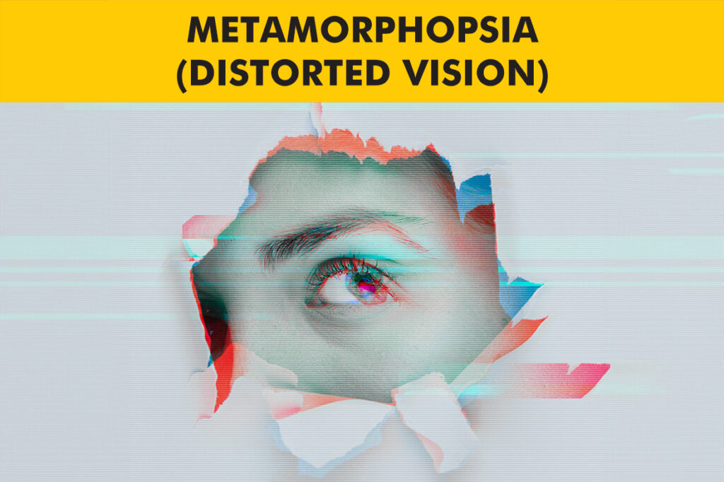 Metamorphopsia (Distorted Vision) – Causes, Symptoms and Treatment