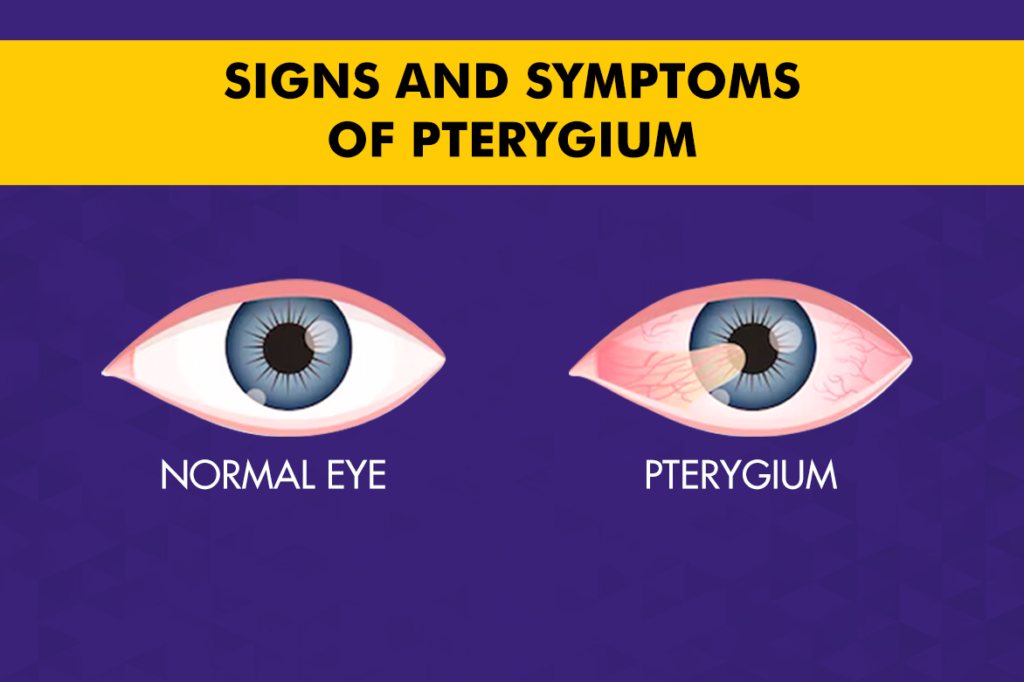 Signs and Symptoms of Pterygium