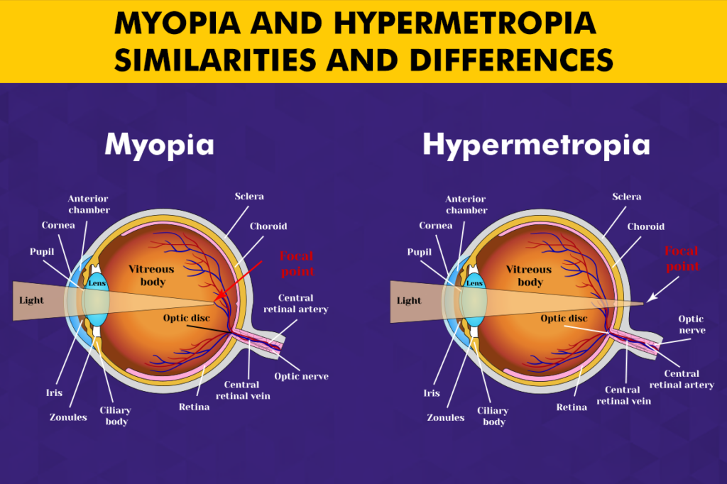 Myopia and Hypermetropia – Similarities and Differences