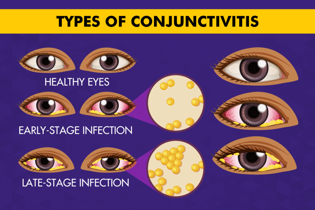 Types of Conjunctivitis