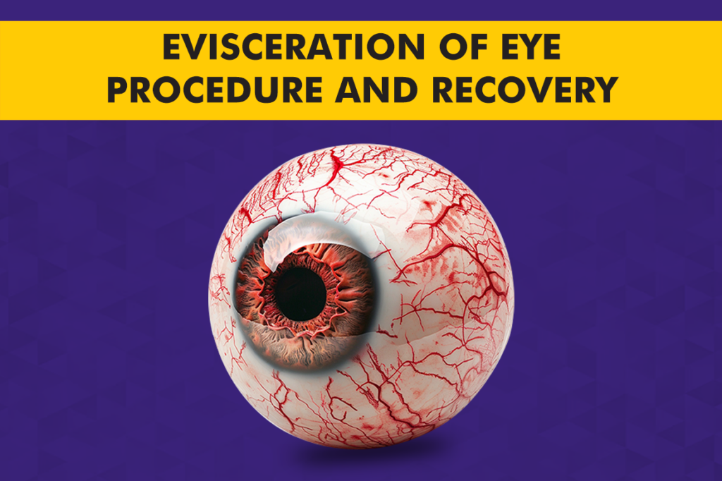 Evisceration of Eye​ – Procedure and Recovery