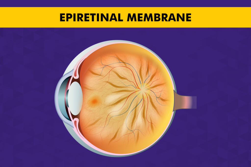 Epiretinal Membrane (ERM): Symptoms, Causes, and Treatment