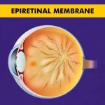 Epiretinal membrane and its impact on vision