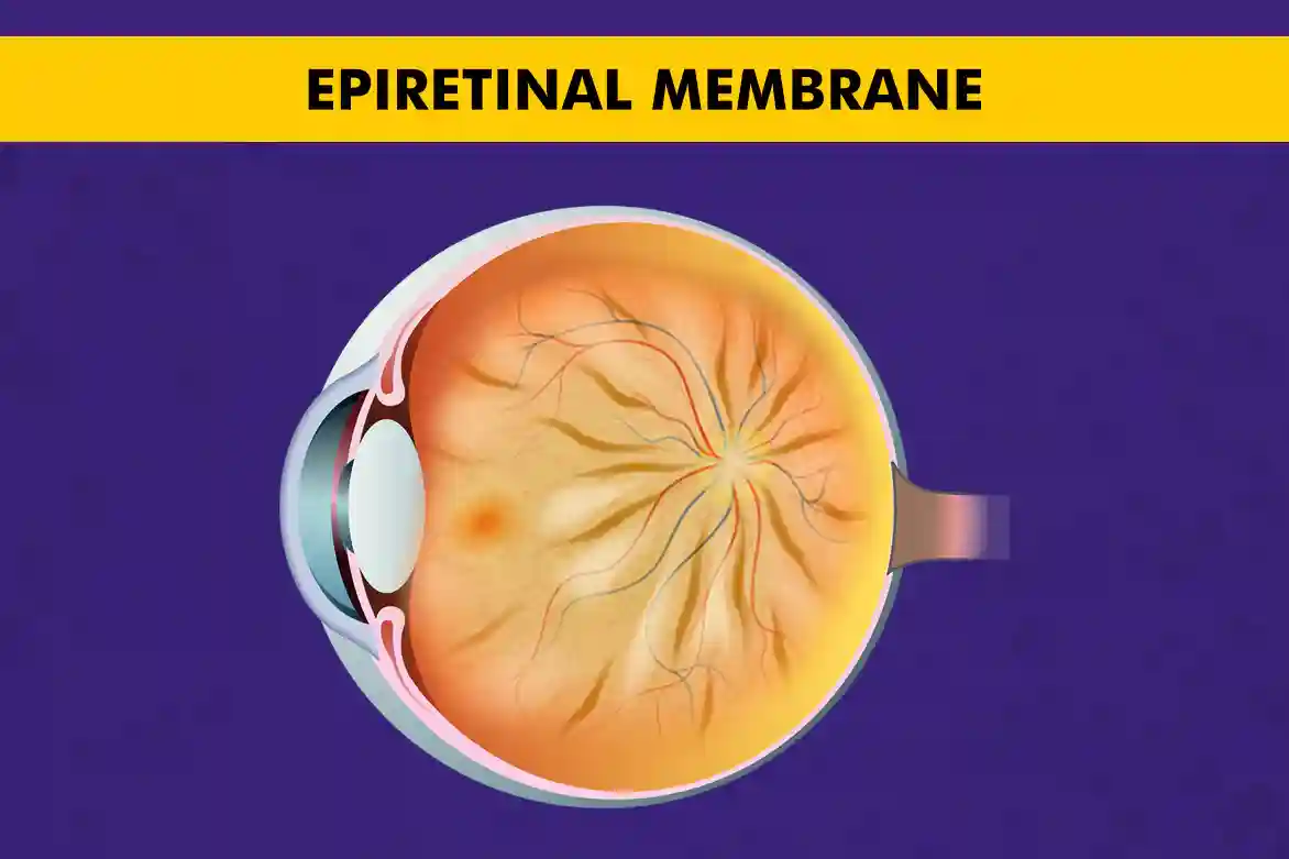 Epiretinal membrane and its impact on vision