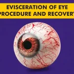 Evisceration-of-Eye-Procedure-and-Recovery