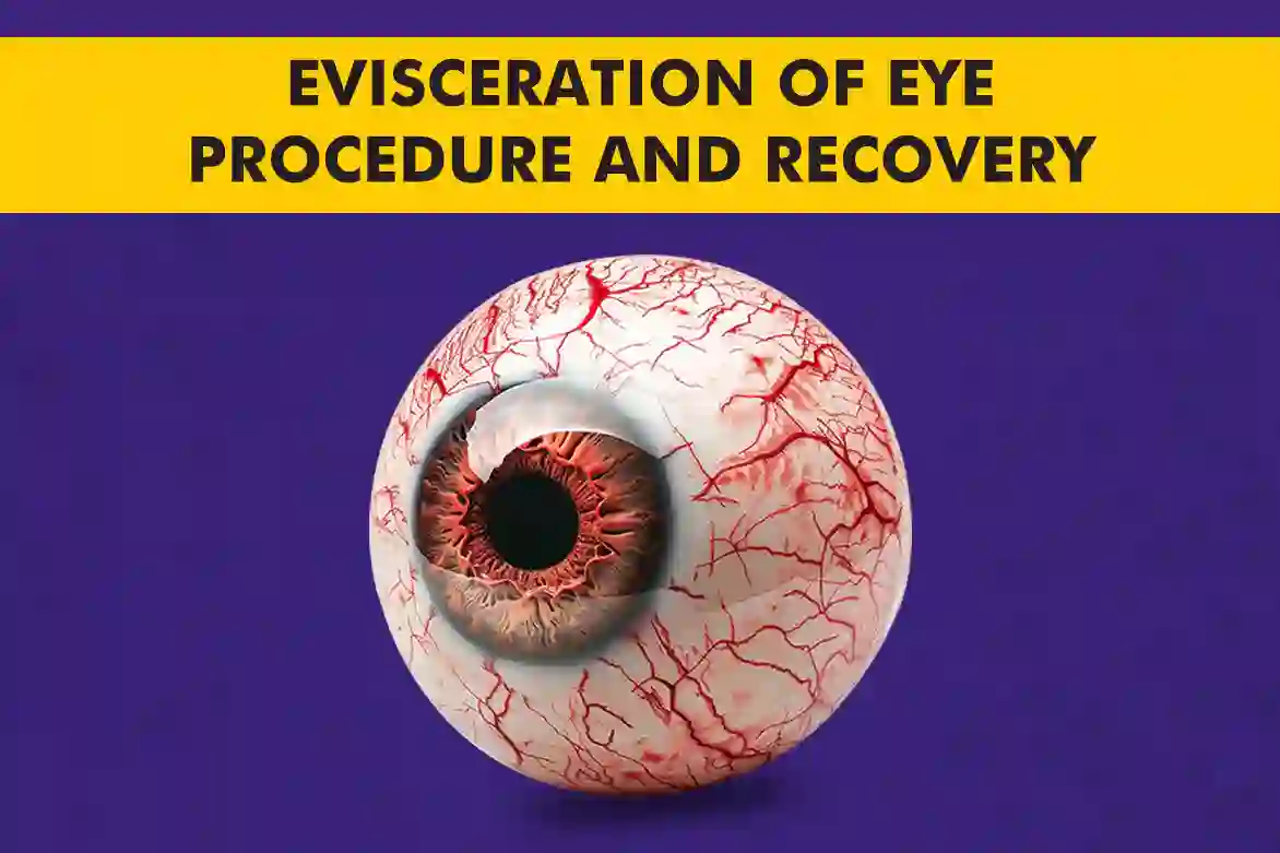 Evisceration-of-Eye-Procedure-and-Recovery