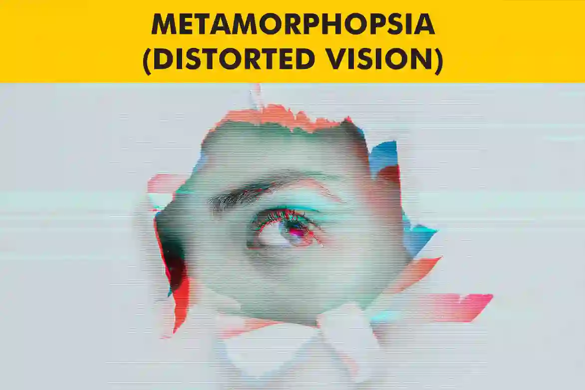 Metamorphopsia distorted vision graphic explaining its effects on sight