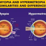 Comparison of myopia and hypermetropia with visual aids