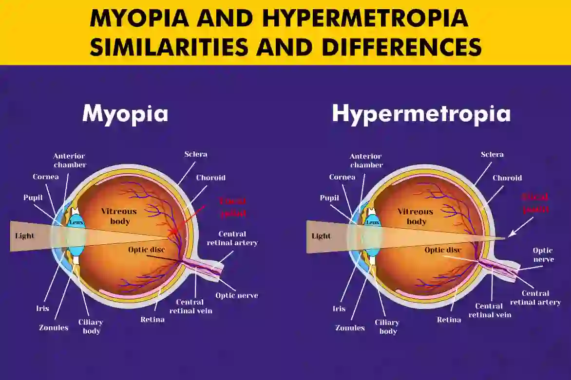 Comparison of myopia and hypermetropia with visual aids