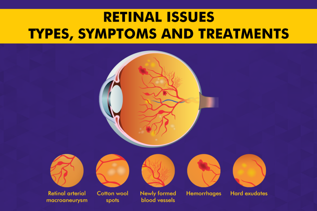 Retinal Issues – Types, Symptoms and Treatments