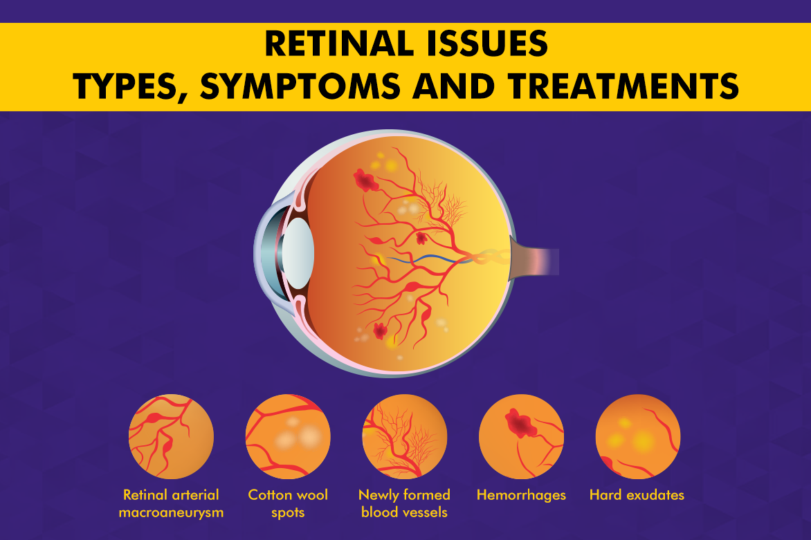 Retinal Issues - Types, Symptoms and Treatments