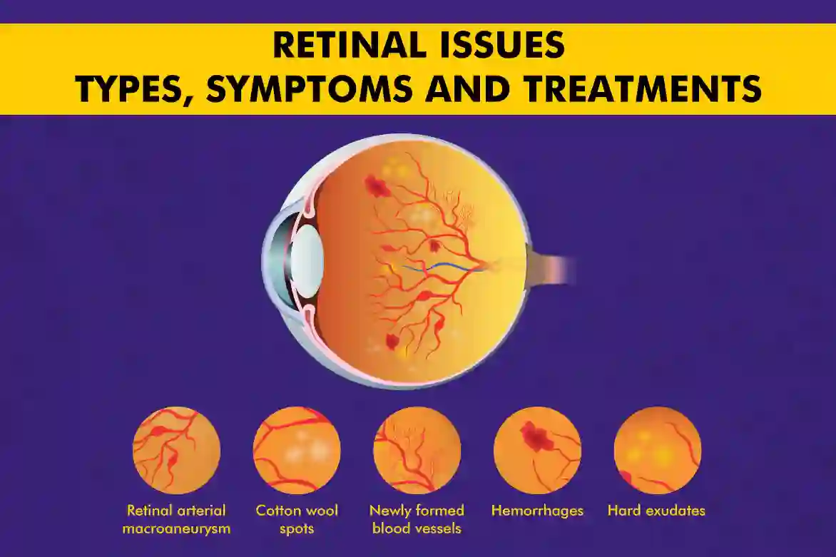 Retinal-Issues-Types-Symptoms-and-Treatments