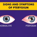 Signs and symptoms of pterygium