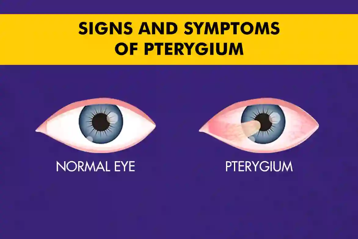 Signs and symptoms of pterygium