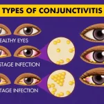 Types of Conjunctivitis