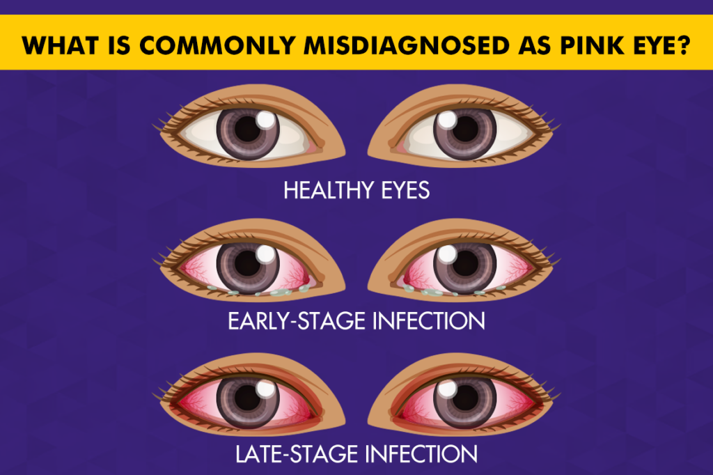 What Is Commonly Misdiagnosed as Pink Eye?