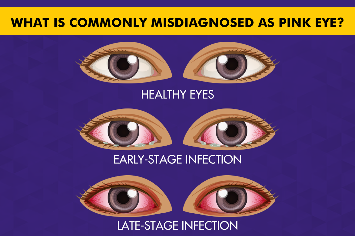 What Is Commonly Misdiagnosed as Pink Eye?