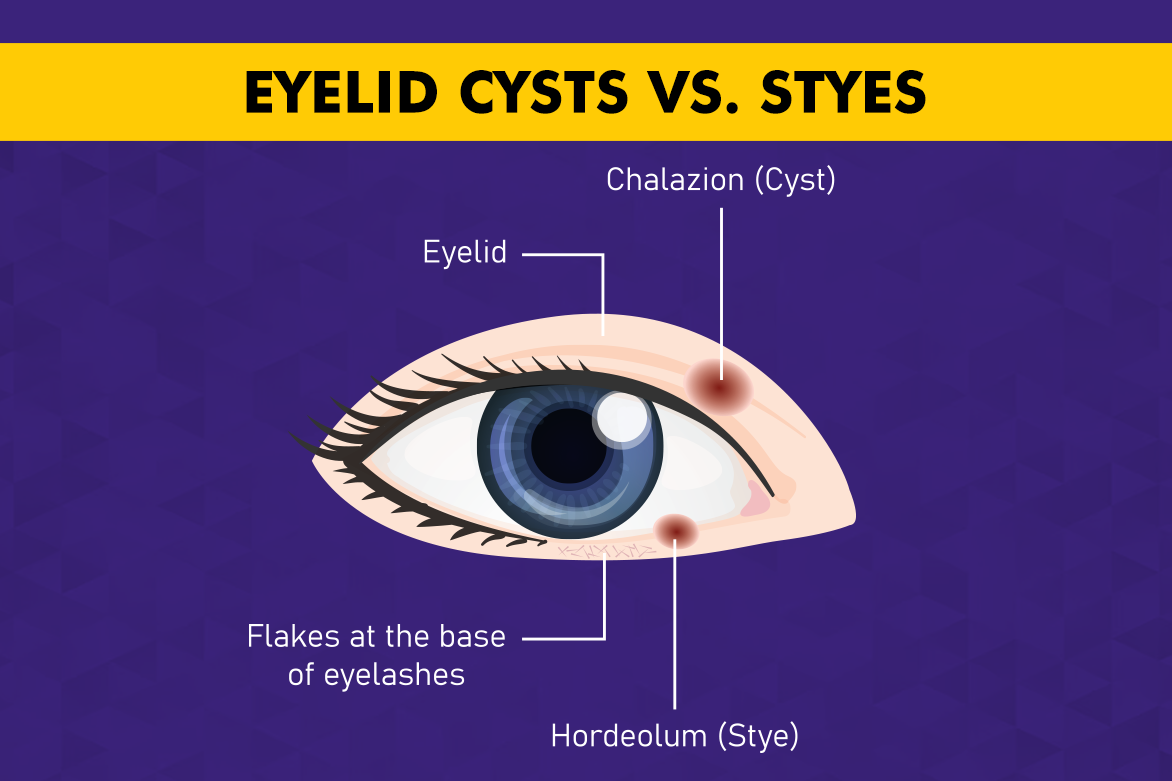 Eyelid Cysts vs. Styes