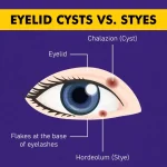 Eyelid-Cysts-vs.-Styes