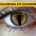 Coloboma Eye Disorder