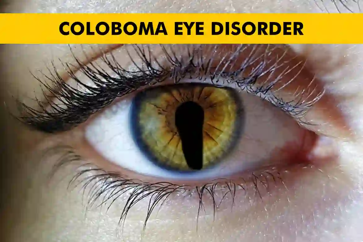 Coloboma Eye Disorder