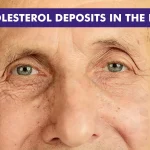 Cholesterol Deposits in the Eyes: Causes & Treatments