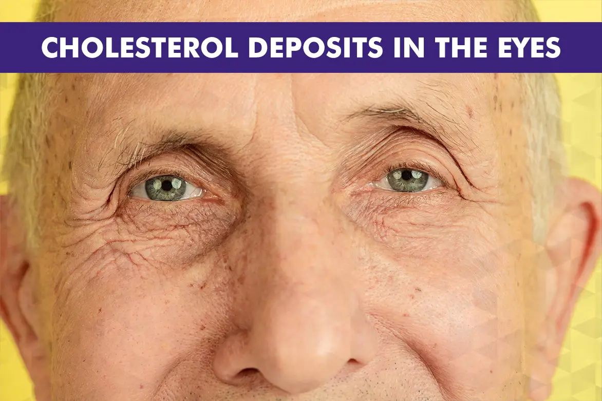 Cholesterol Deposits in the Eyes: Causes & Treatments