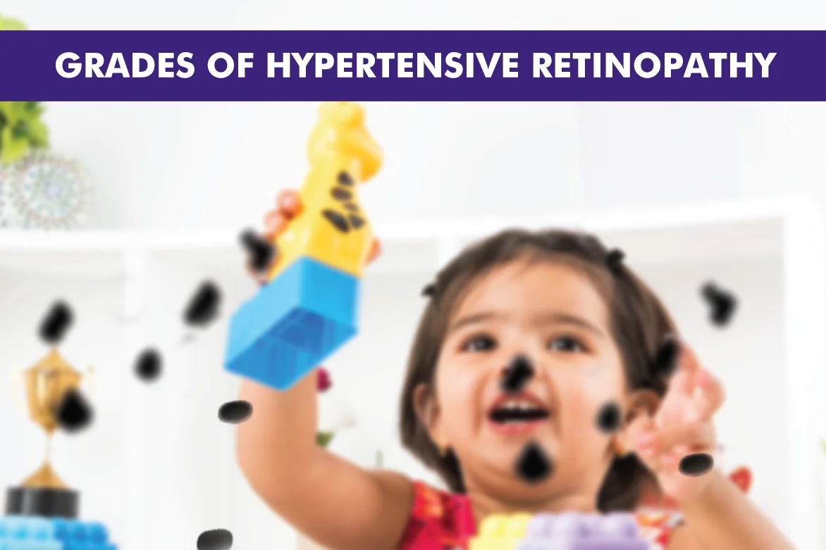 Grades of Hypertensive Retinopathy