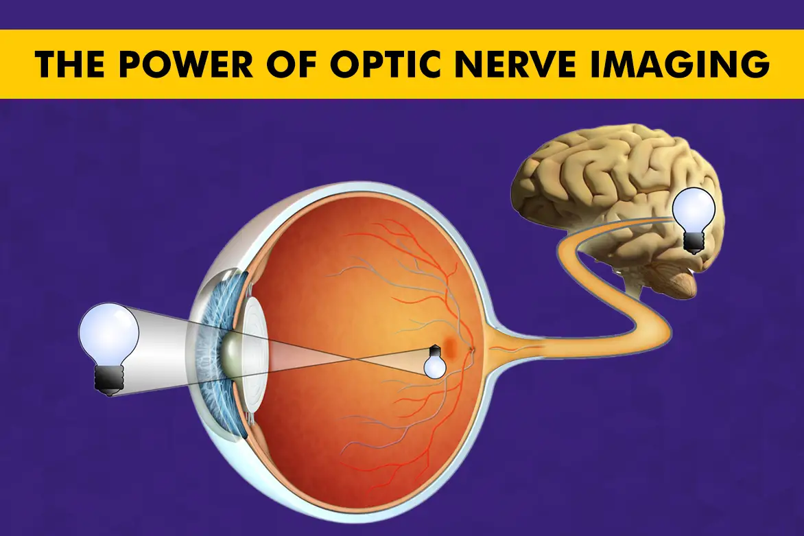 Seeing Beyond Vision: The Power of Optic Nerve Imaging