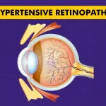 Hypertensive Retinopathy - A Comprehensive Guide