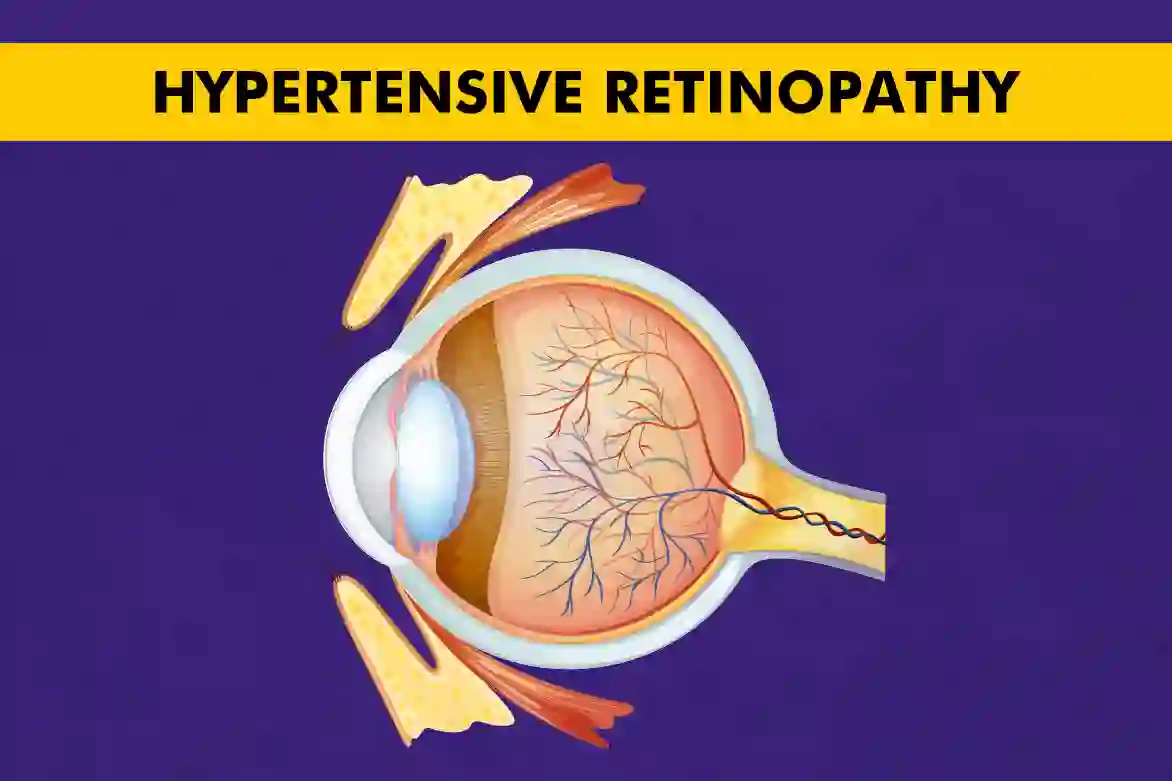 Hypertensive Retinopathy - A Comprehensive Guide