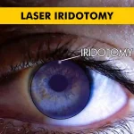 Laser Iridotomy for Glaucoma Patients