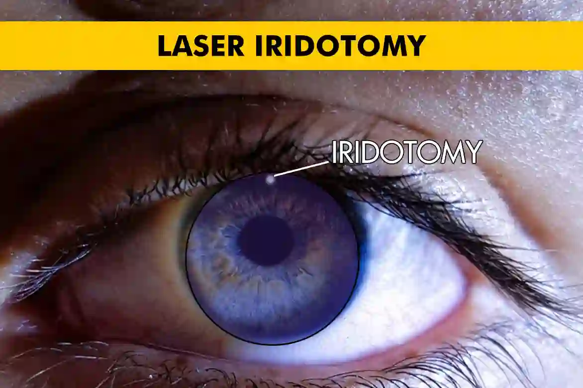 Laser Iridotomy for Glaucoma Patients