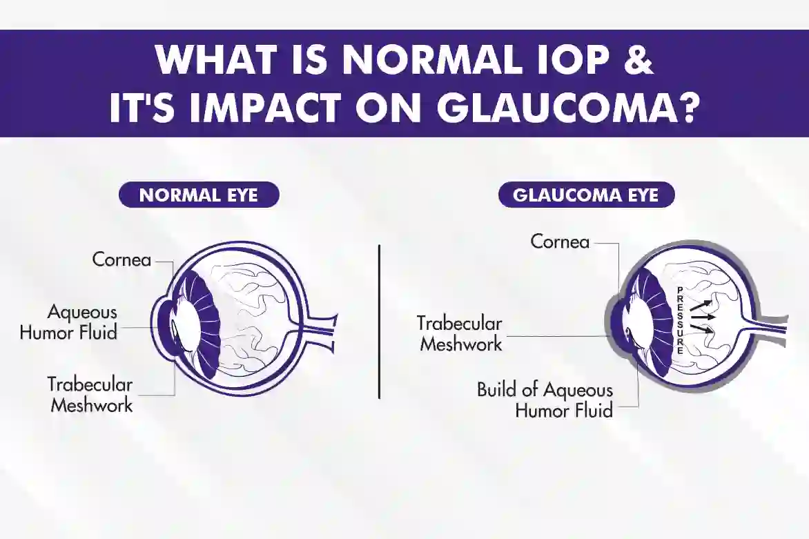 What is Normal IOP & Its Role in Glaucoma?