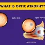 Optic Atrophy - Understanding the Condition