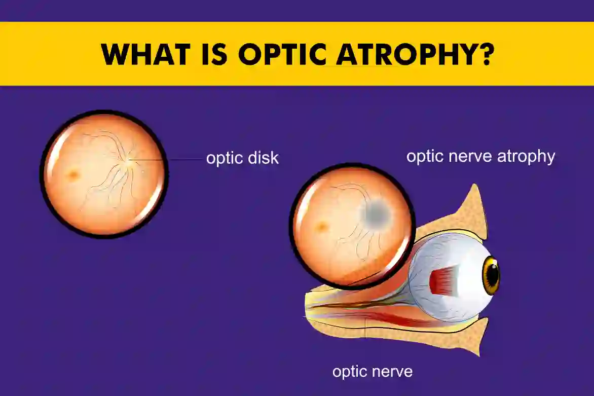 Optic Atrophy - Understanding the Condition